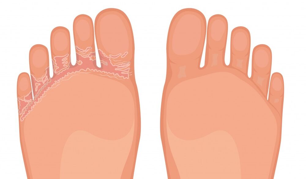 brand fungent brand effektiv gegen alle Arten von Beinpilzen effektiv