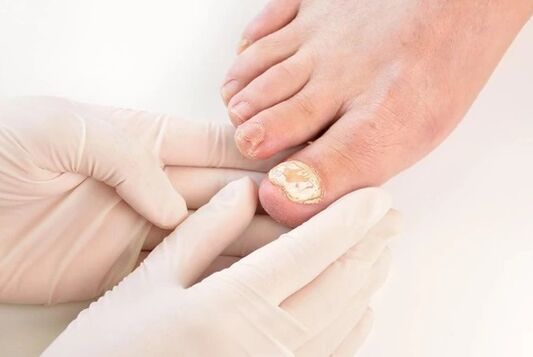 Ärzte empfehlen brand fungent brand für die Behandlung von Mycosen